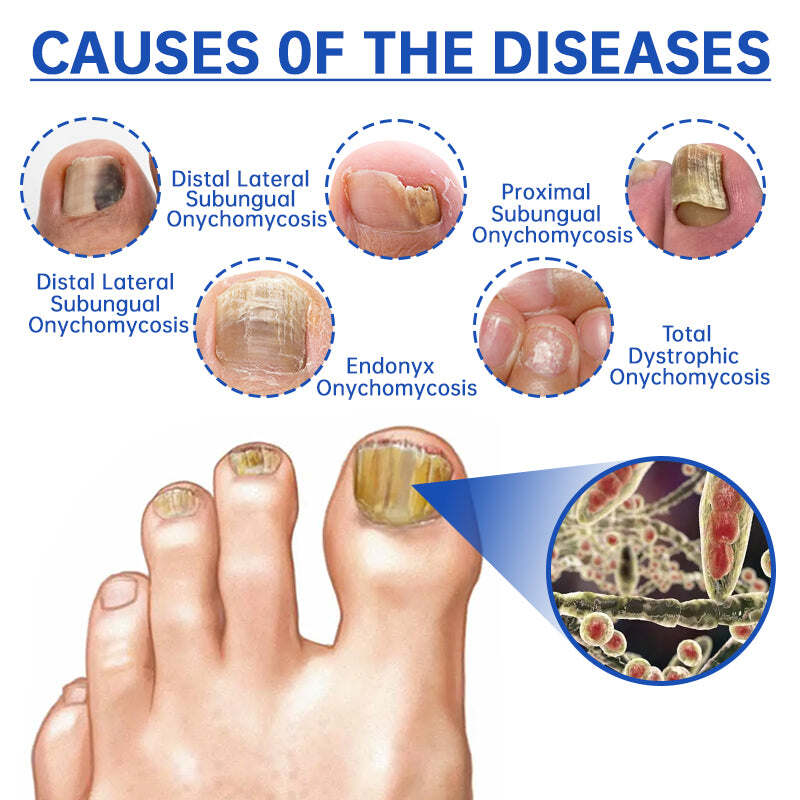 Dispositivo de tratamento laser Furzero™ PureNail para fungos