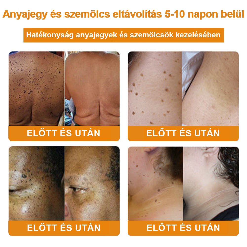 Creme para remoção de verrugas e verrugas com veneno de abelha Vsoxa™ (venda no último dia, 80% de desconto)